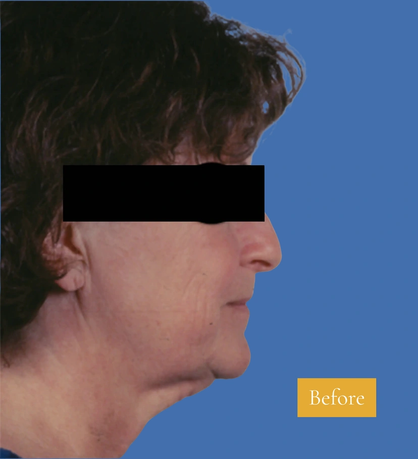 Rhinoplasty - Patient 3 (before)