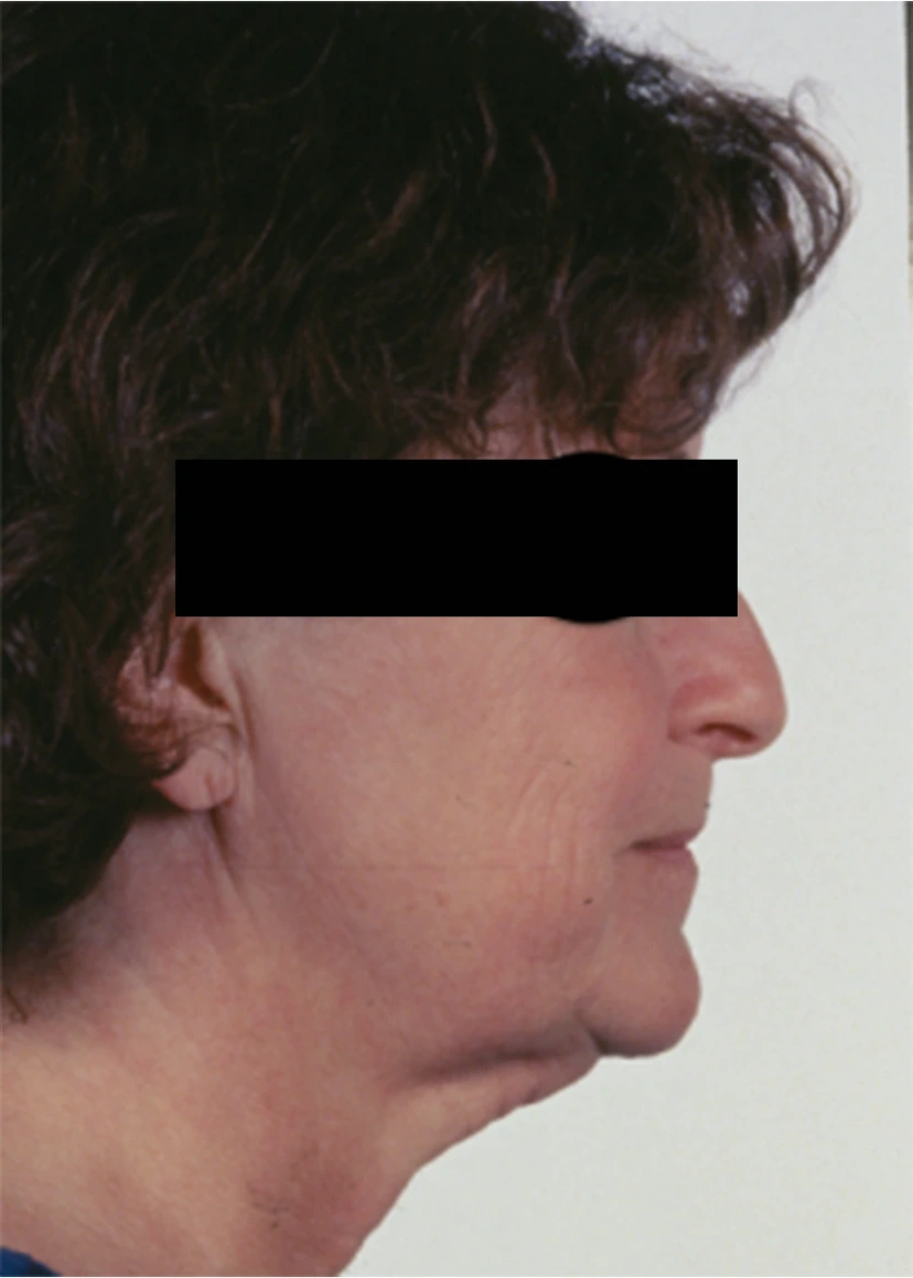 Rhinoplasty - Patient 3 (before)