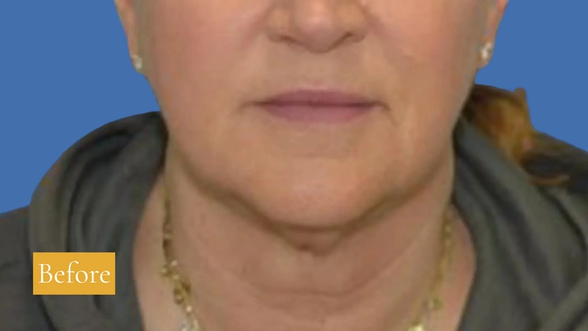 Facelift - Patient 1 (front view after)