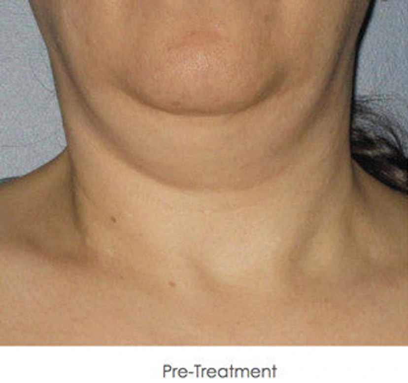 Ultherapy patient 6 result photo
