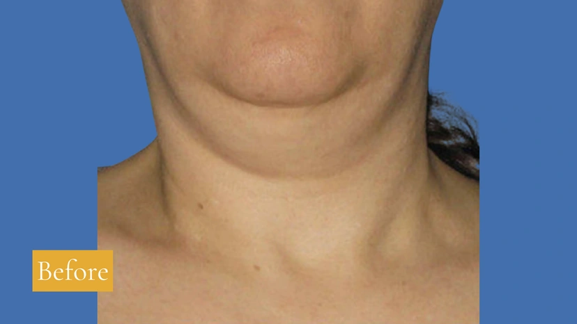 Ultherapy patient 6 result photo