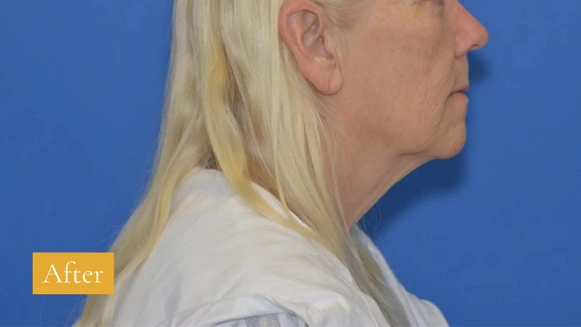 Facelift - Patient 4 (before)