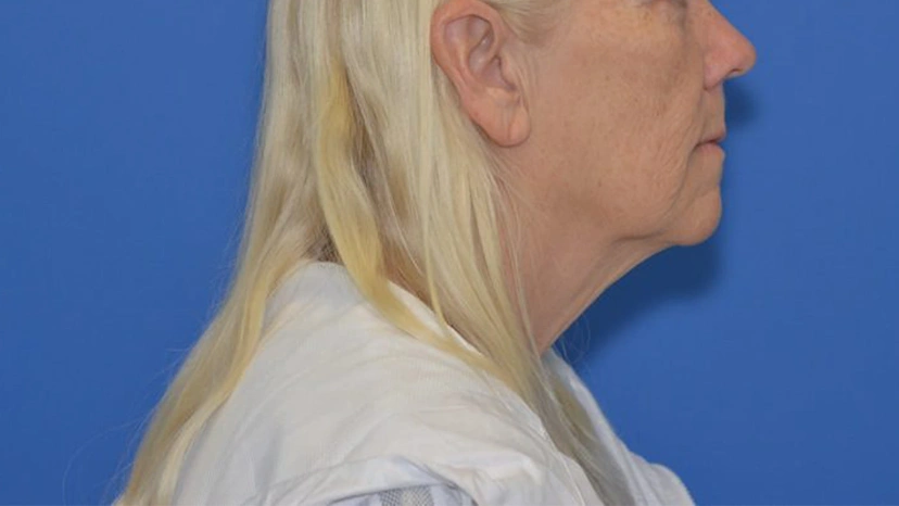 Facelift - Patient 4 (before)