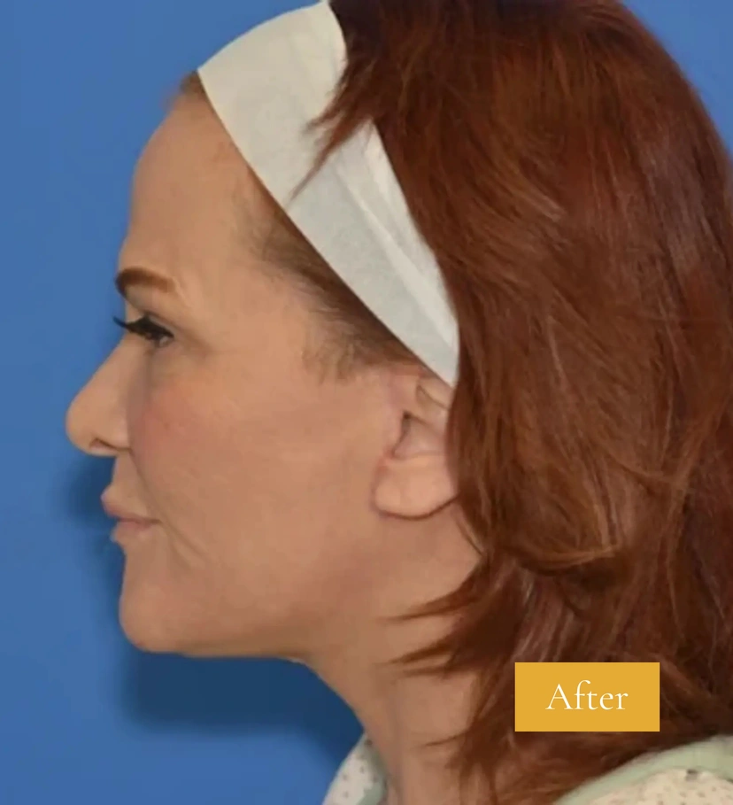 Facelift - Patient 14 - Set 1 - After