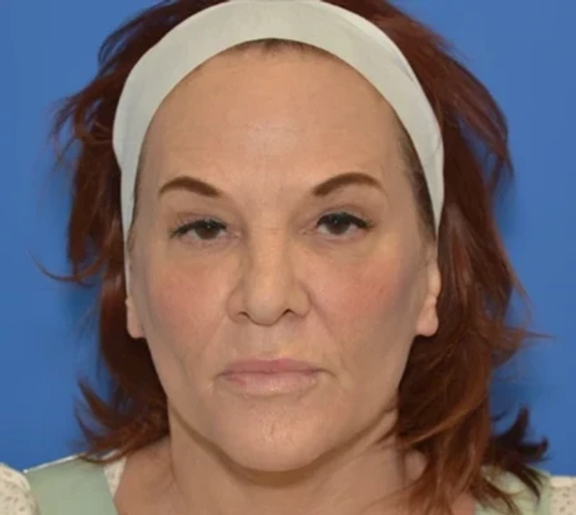 Facelift - Patient 14 - Set 1 - After