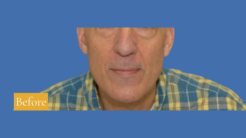 Lower Eyelid Surgery - Patient 3 (before)