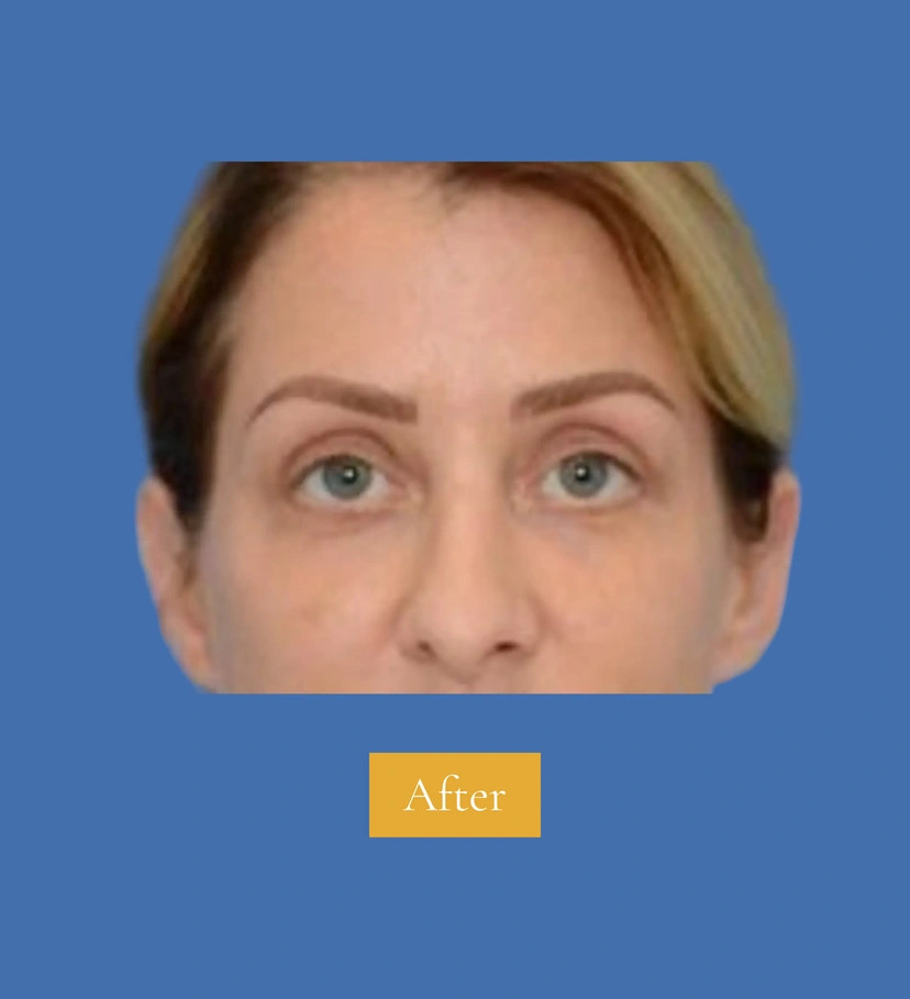 Upper Eyelid Surgery - Patient 4 (front view after)