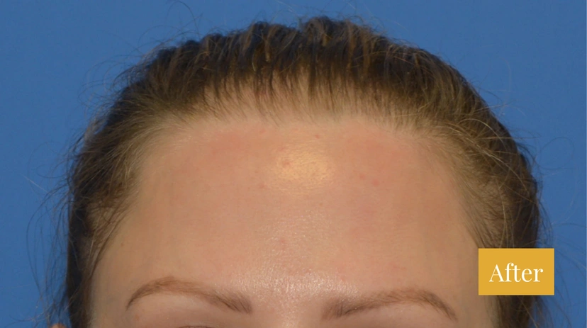 Hair Restoration - Patient 3 (after)