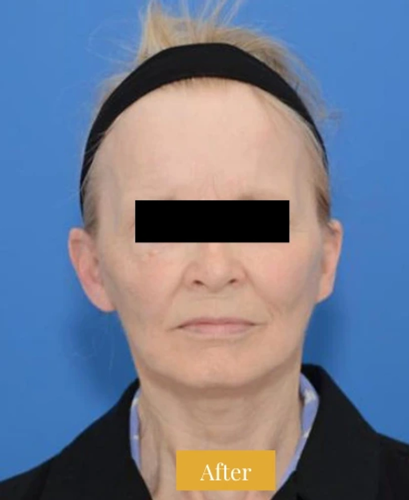 Mini Facelift/Short Scar - Patient 4 (front view after)