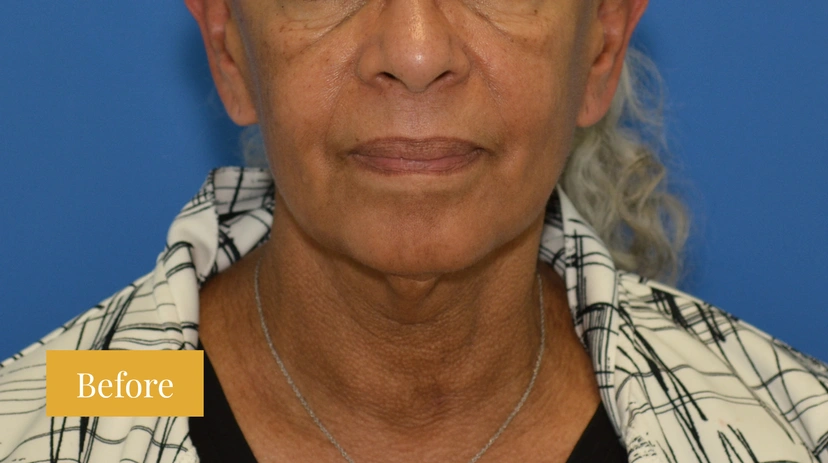 Facelift - Patient 8 - Set 1 - Before