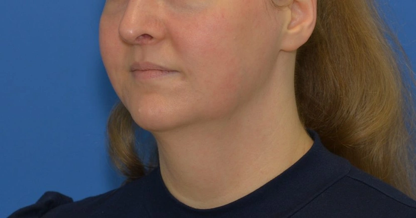 Morpheus8 RF Microneedling - Patient 1 (after)