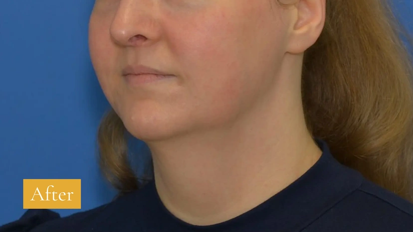 Morpheus8 RF Microneedling - Patient 1 (after)