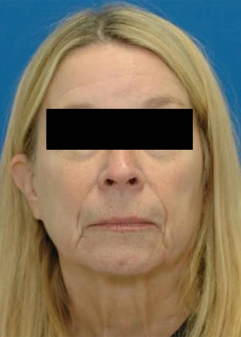 Liquid Facelift - Patient 1 (before)