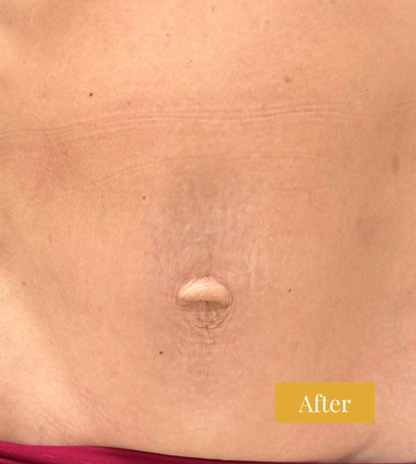 Fraxel - Patient 5 - Set 1 - After