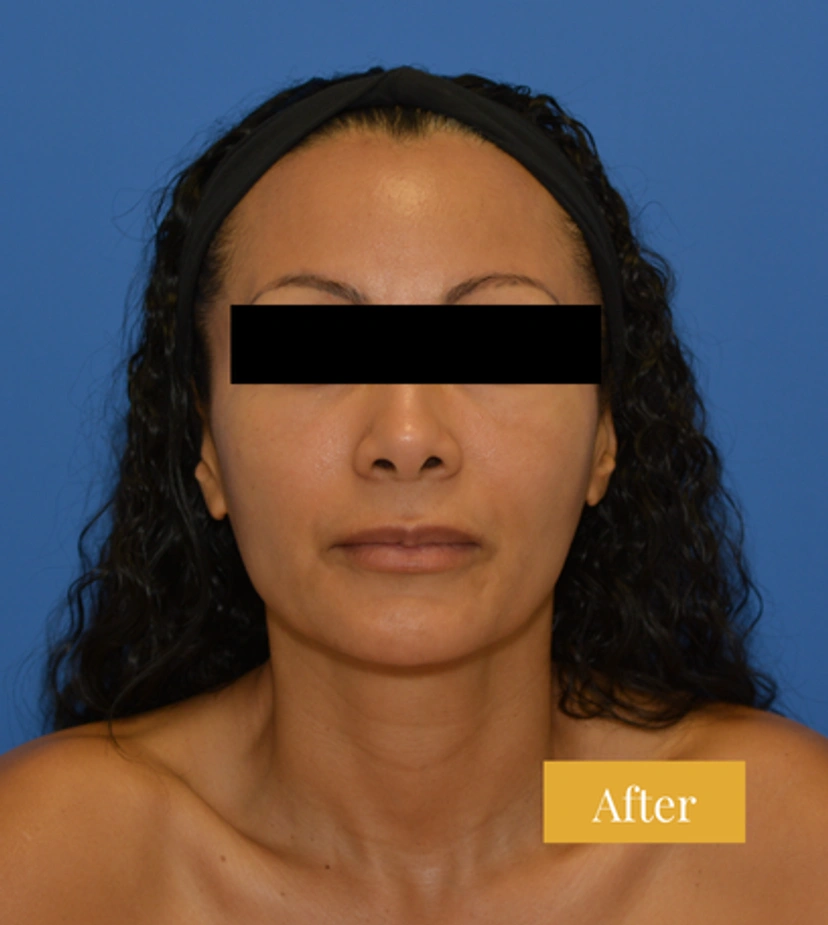 Eyebrow Lift - Patient 3 - Set 1 - After