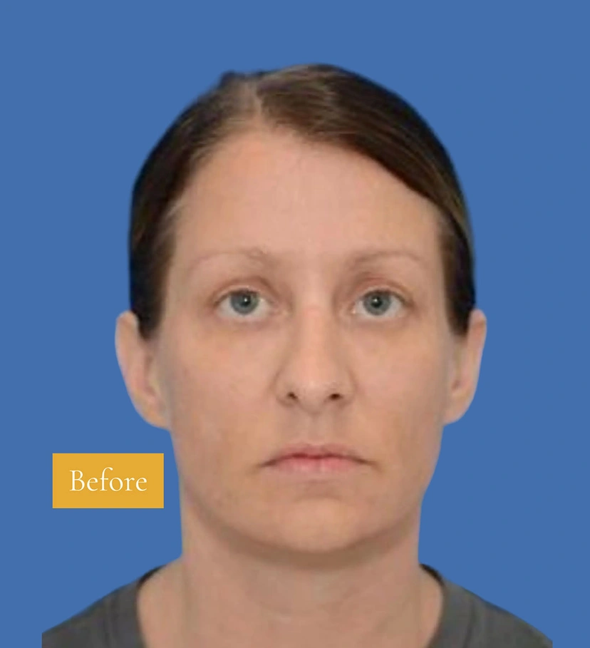 Lower Eyelid Surgery - Patient 2 (front view before)