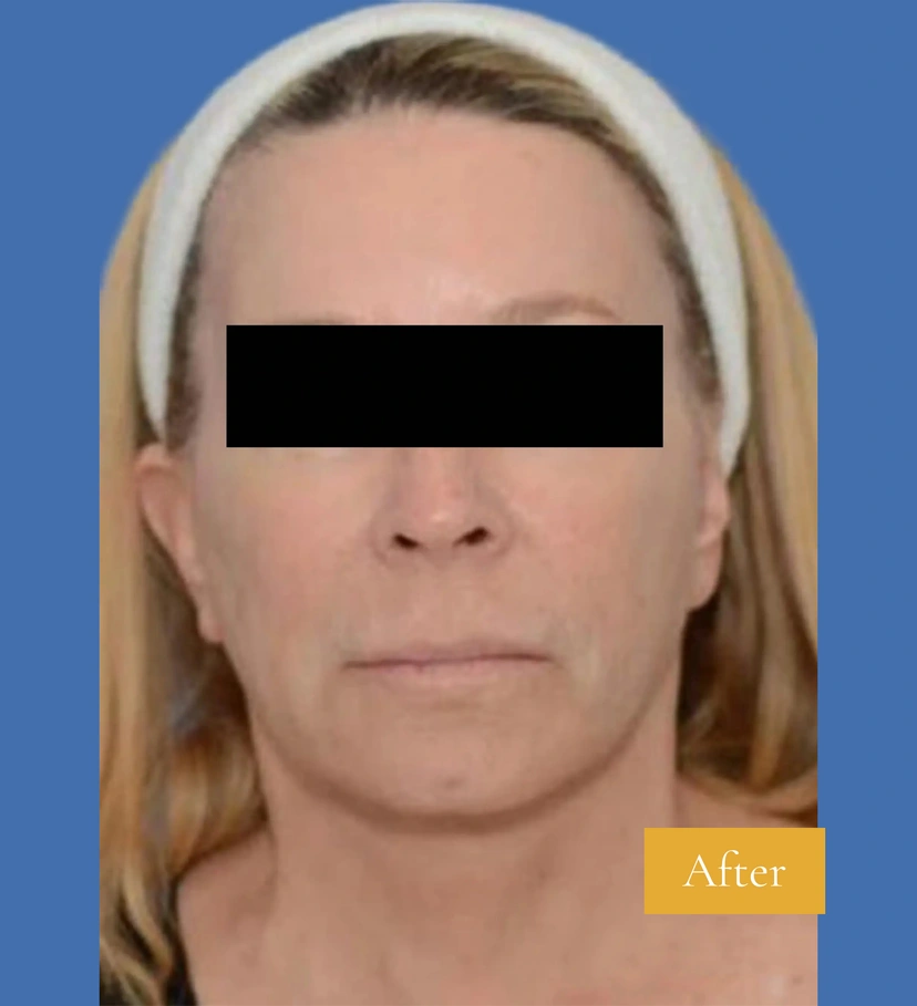 Mini Facelift/Short Scar - Patient 2 (before)