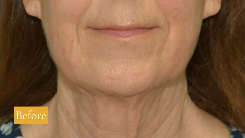 Facelift - Patient 1 (front view before)