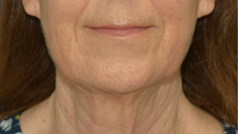 Facelift - Patient 1 (front view before)