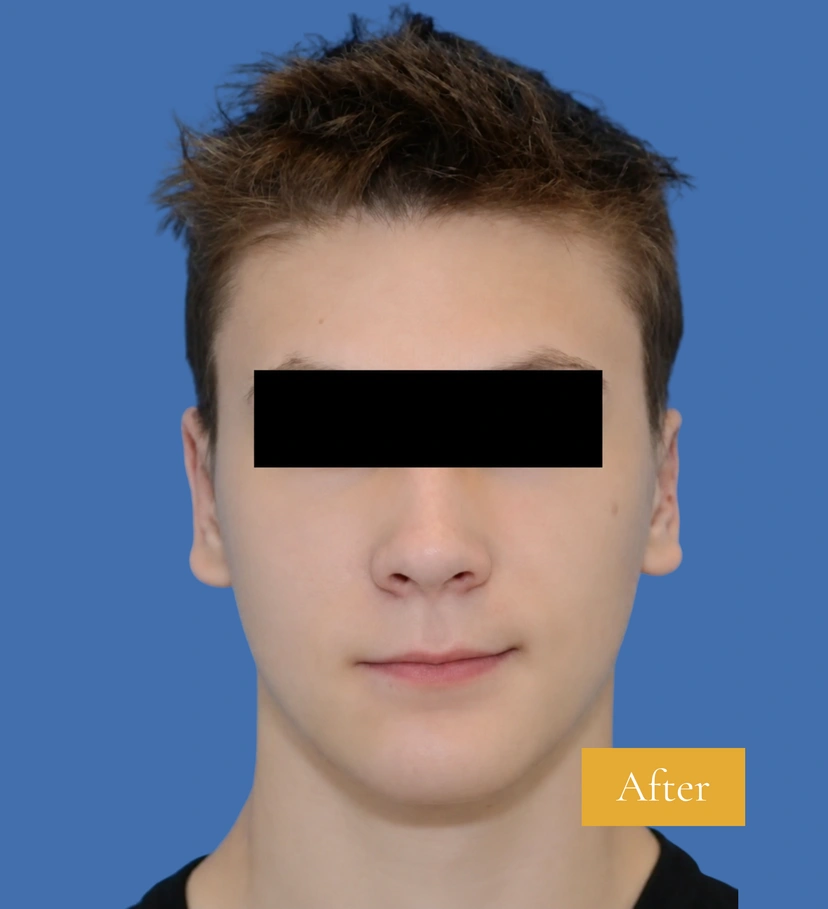 Otoplasty Ear Surgery - Patient 1 (after)
