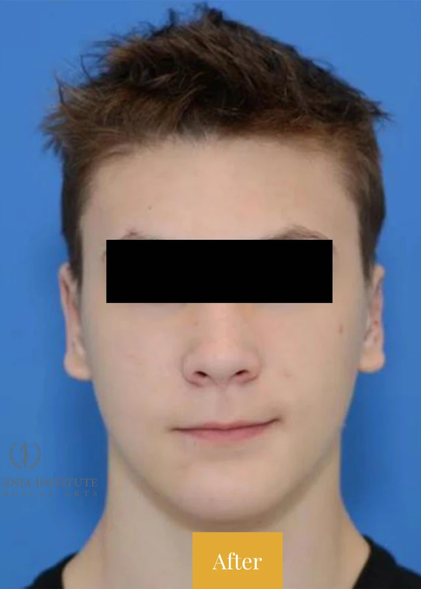 Otoplasty Ear Surgery - Patient 1 (after)