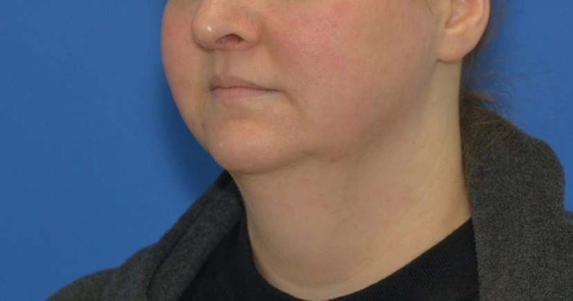 Morpheus8 RF Microneedling - Patient 1 (before)