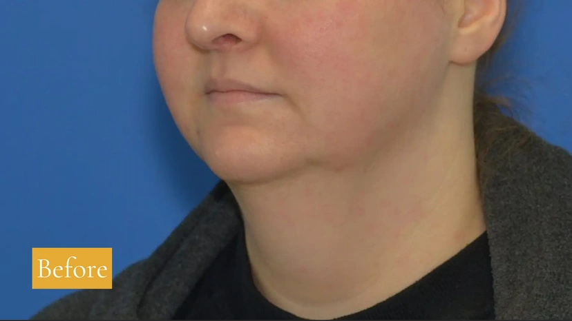 Morpheus8 RF Microneedling - Patient 1 (before)