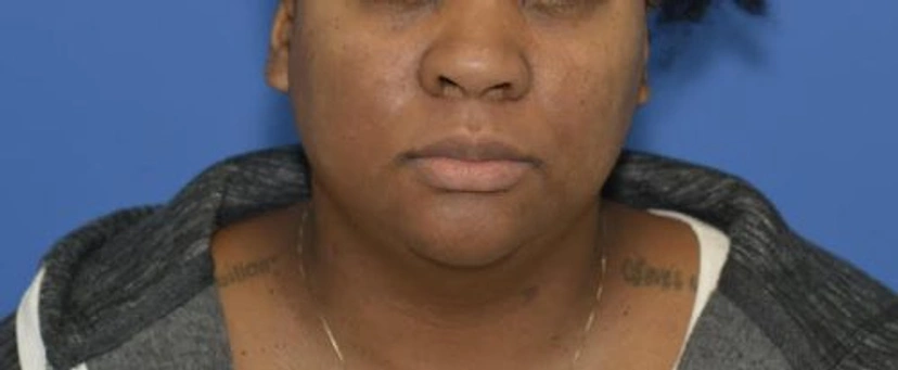 Microneedling - Patient 1 (front view before)