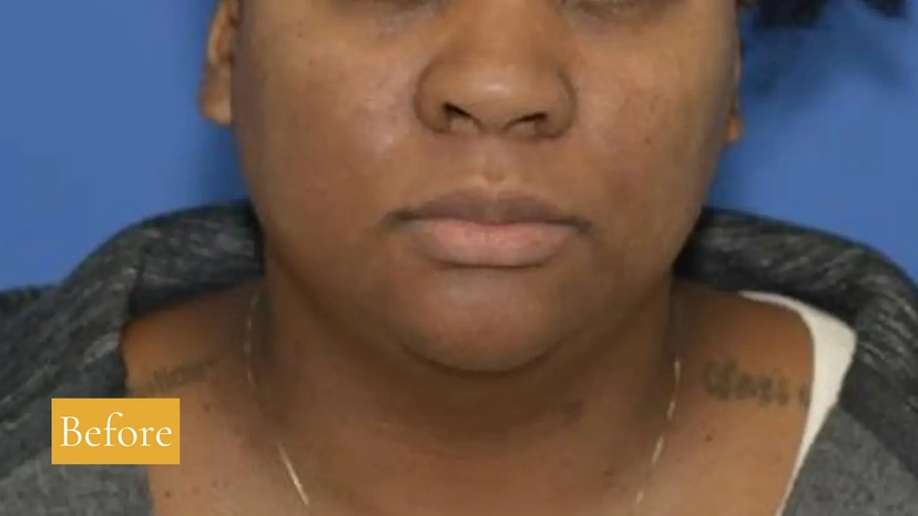 Microneedling - Patient 1 (front view before)