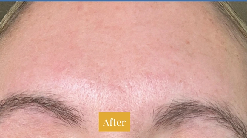 Fraxel - Patient 4 - Set 1 - After