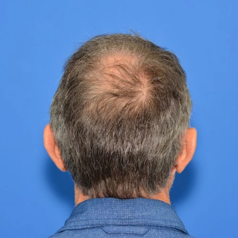 Hair Restoration - Patient 1 (before)