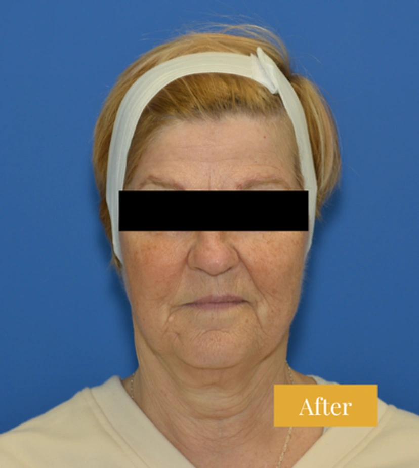 Eyebrow Lift - Patient 4 - Set 1 - After