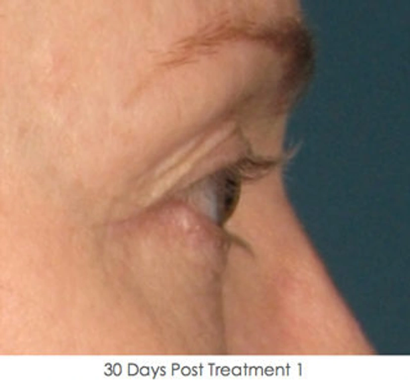 Ultherapy patient 1 result photo