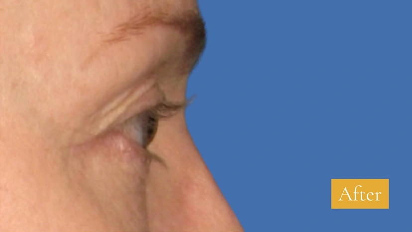 Ultherapy patient 1 result photo