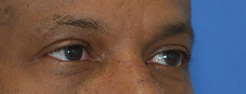 Lower Eyelid Surgery - Patient 4 (before)