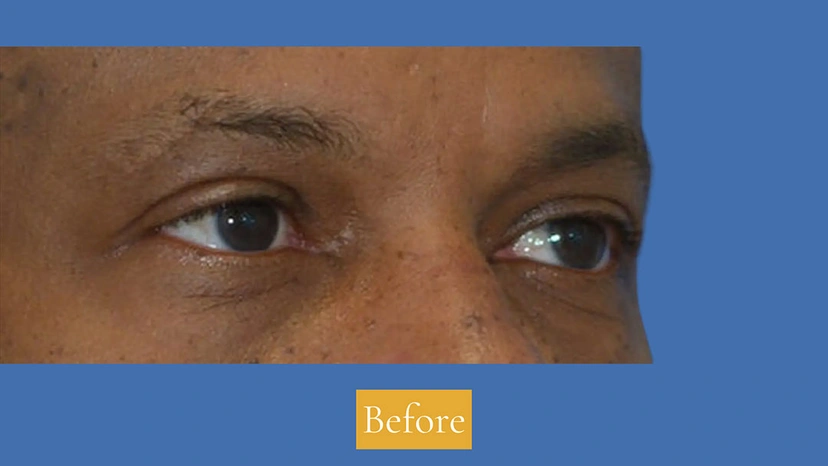 Lower Eyelid Surgery - Patient 4 (before)