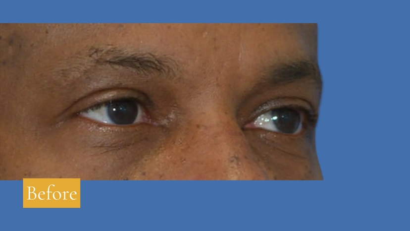 Lower Eyelid Surgery - Patient 4 (before)
