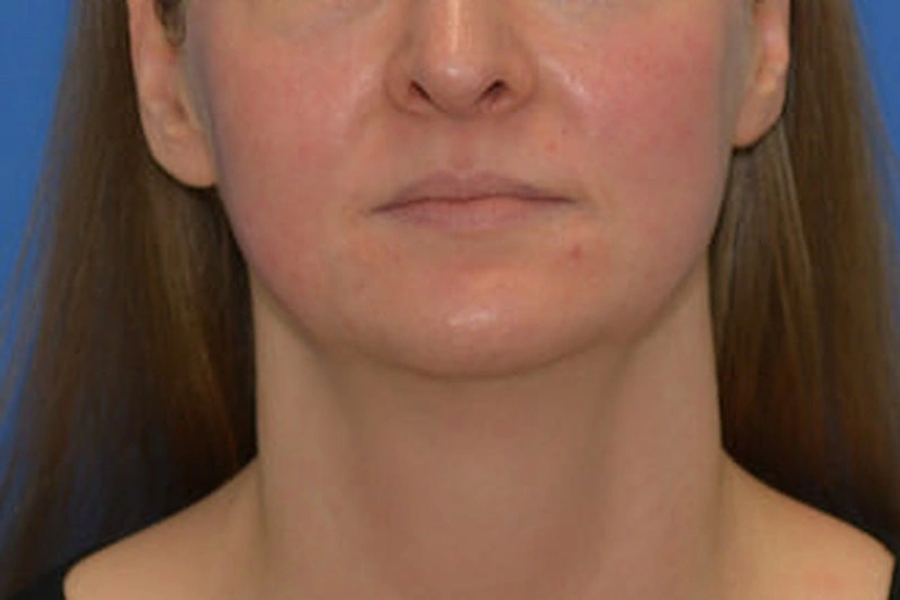 Morpheus8 RF Microneedling - Patient 10 (after)