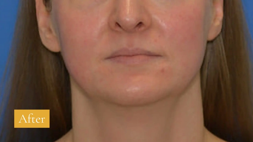 Morpheus8 RF Microneedling - Patient 10 (after)