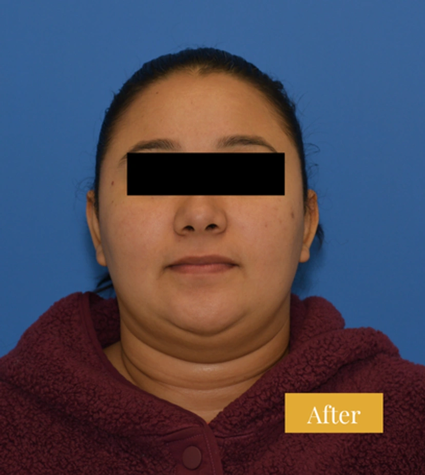 Otoplasty Ear Surgery - Patient 2 - After