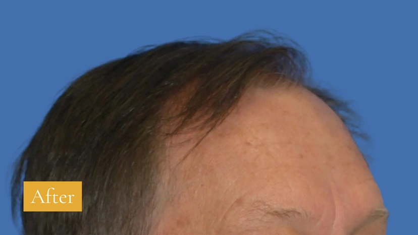 Botox - Patient 3 (after)