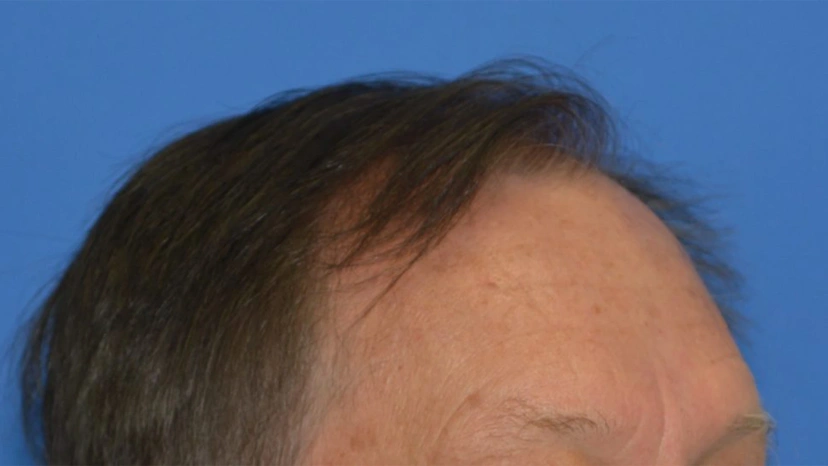 Botox - Patient 3 (after)