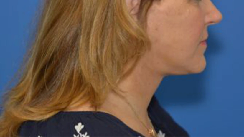 Facelift - Patient 1 (side view after)