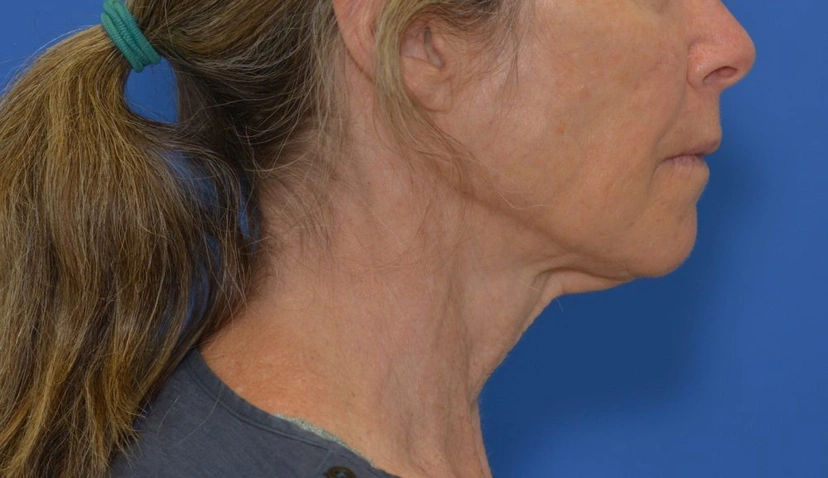 Morpheus8 RF Microneedling - Patient 2 (right side view before)