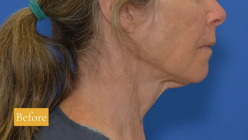 Morpheus8 RF Microneedling - Patient 2 (right side view before)