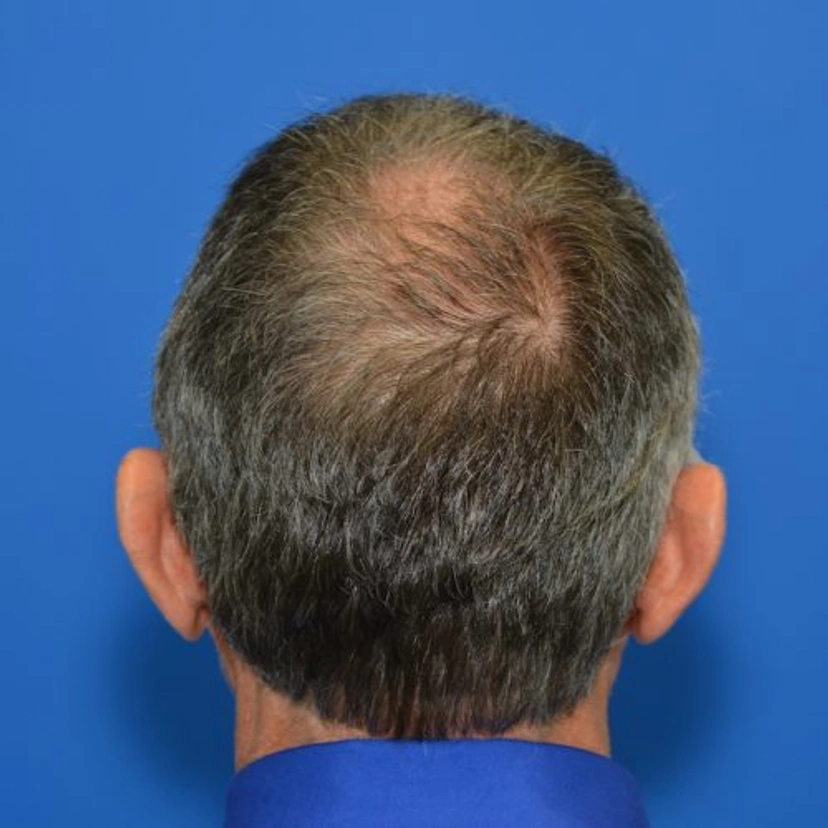 Hair Restoration - Patient 1 (after)