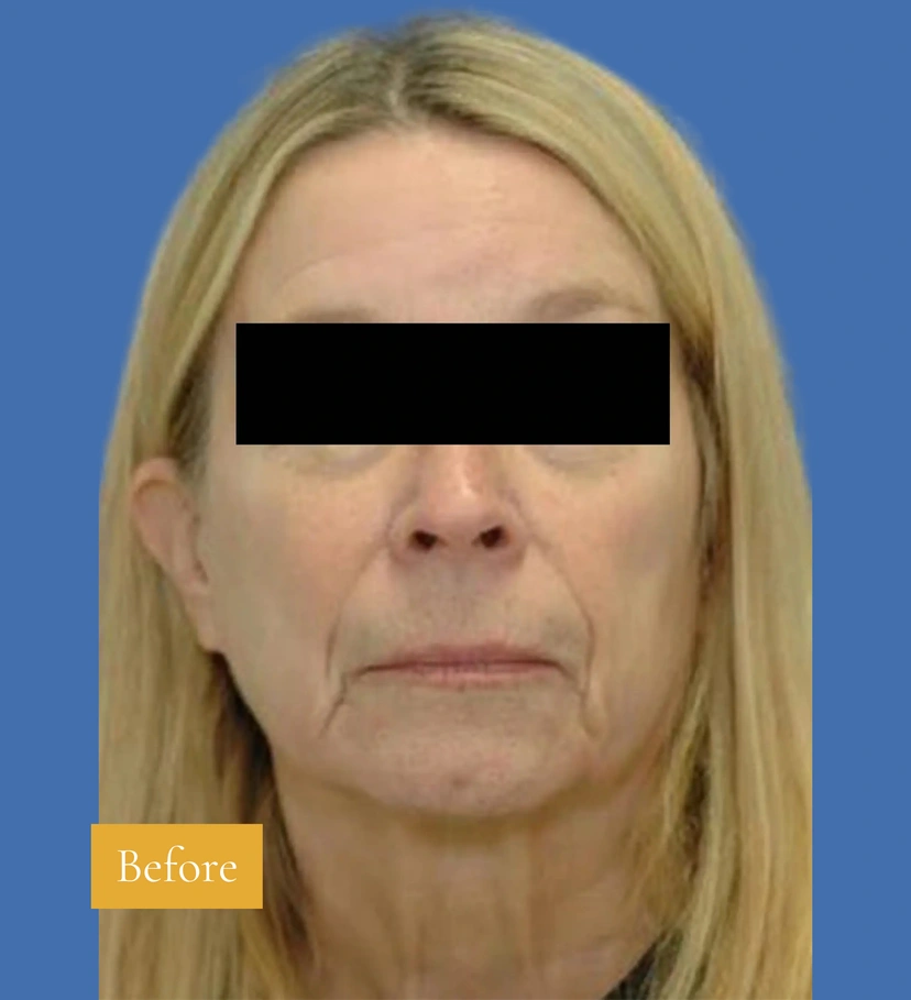 Mini Facelift/Short Scar - Patient 2 (after)