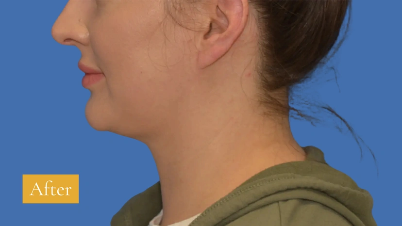 Chin Liposuction - Patient 1 (after)