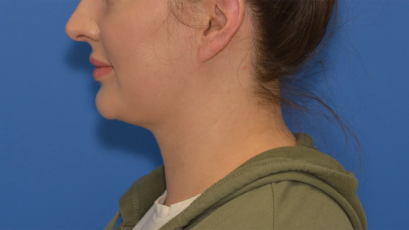 Chin Liposuction - Patient 1 (after)