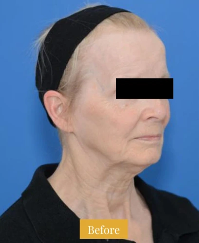Mini Facelift/Short Scar - Patient 4 (half-turn right view before)